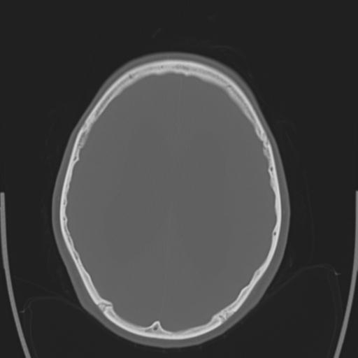 File:Obstructive hydrocephalus (Radiopaedia 30453-31119 Axial bone window 12).jpg