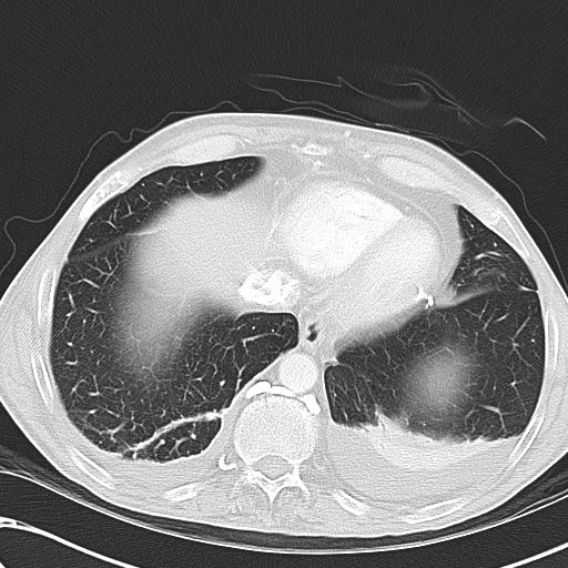 File:Obstructive superior vena cava tumor thrombus (Radiopaedia 28046-28306 Axial lung window 44).jpg