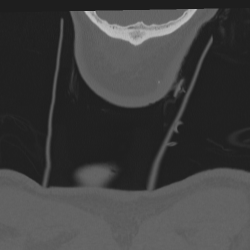 File:Occipital condyle fracture (Radiopaedia 33467-34517 Coronal bone window 86).png