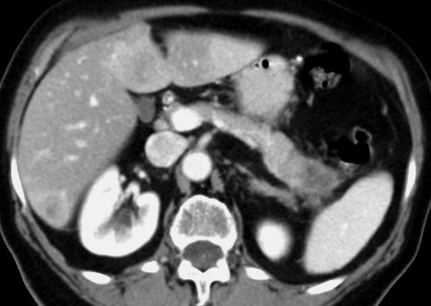 File:Pancreatic tail adenocarcinoma with hepatic metastases (Radiopaedia 15862).jpg