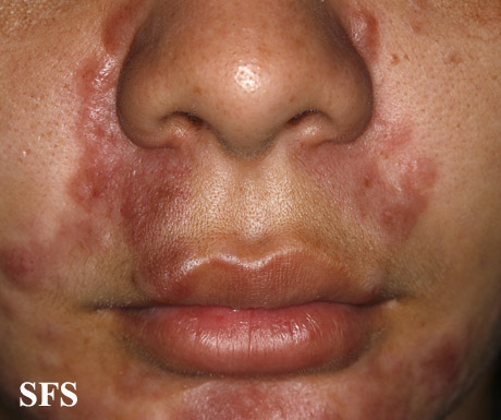 File:Sarcoidosis (Dermatology Atlas 25).jpg