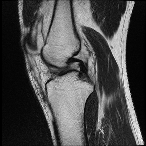 File:ACL acute full thickness tear - deep lateral femoral sulcus sign (Radiopaedia 38594-40740 Sagittal T2 9).jpg