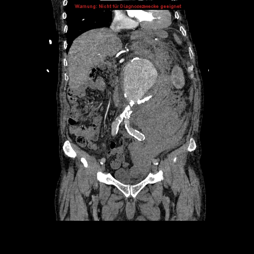 Abdominal aortic aneurysm- extremely large, ruptured (Radiopaedia 19882-19921 Coronal C+ arterial phase 47).jpg