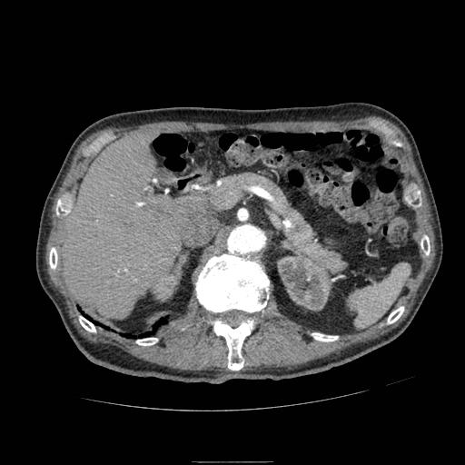 Abdominal aortic aneurysm (Radiopaedia 13341-13340 Axial C+ arterial phase 54).jpg