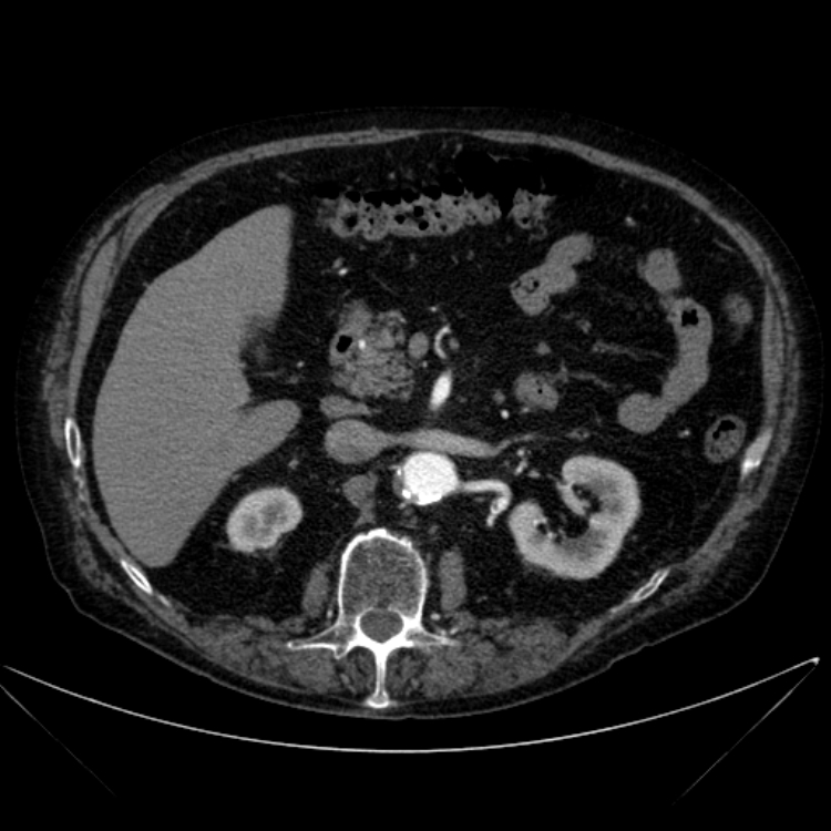 Abdominal aortic aneurysm (Radiopaedia 25855-26001 Axial C+ arterial phase 49).jpg