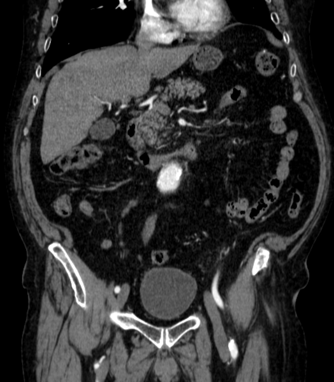 Abdominal aortic aneurysm (Radiopaedia 25855-26001 Coronal C+ arterial phase 20).jpg