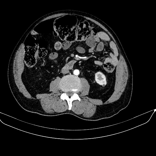 Abdominal aortic aneurysm (Radiopaedia 67117-76452 Axial C+ arterial phase 71).jpg