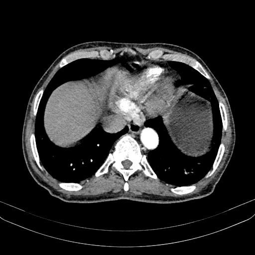 File:Abdominal aortic aneurysm (Radiopaedia 83581-98689 Axial C+ arterial phase 14).jpg