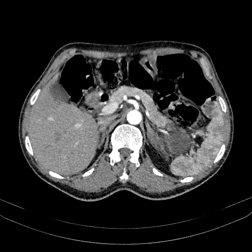 Abdominal aortic aneurysm (Radiopaedia 83581-98689 Axial C+ arterial phase 38).jpg