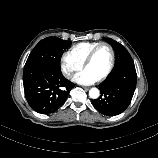Abdominal aortic aneurysm (Radiopaedia 83581-98689 Axial C+ arterial phase 6).jpg