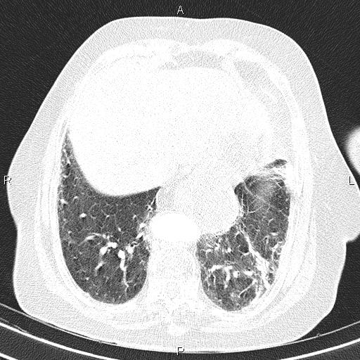Abdominal aortic aneurysm (Radiopaedia 85063-100606 Axial lung window 50).jpg