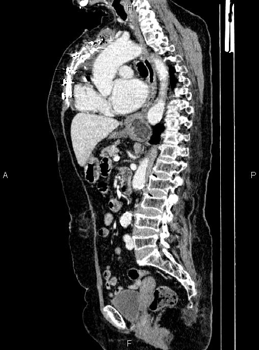Abdominal aortic aneurysm (Radiopaedia 85063-100606 Sagittal C+ arterial phase 44).jpg