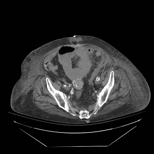 File:Abdominal aortic aneurysm - impending rupture (Radiopaedia 19233-19247 Axial non-contrast 133).jpg