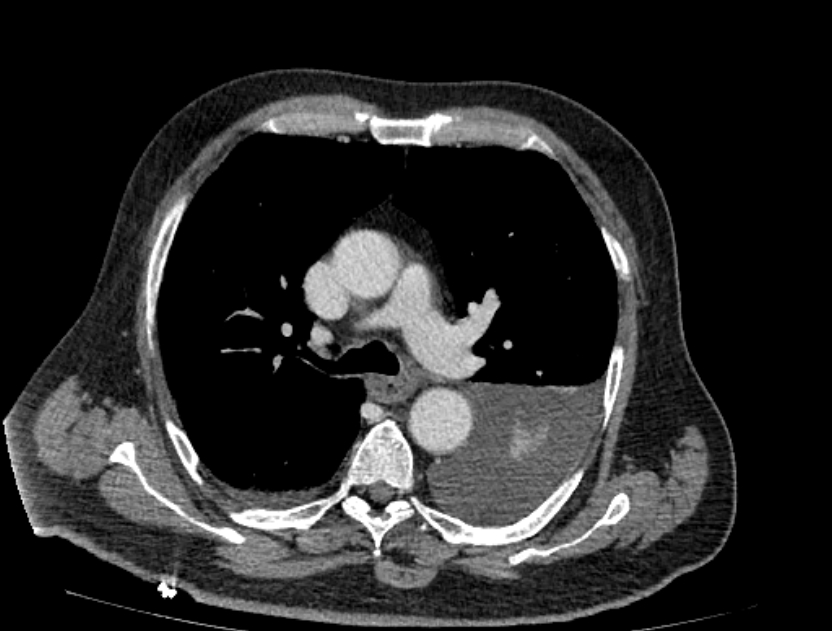 Abdominal aortic aneurysm rupture (Radiopaedia 54179-60362 Axial C+ portal venous phase 45).jpg