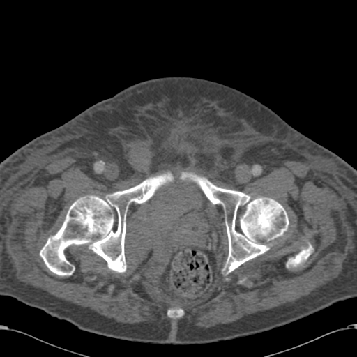 Abdominal hematoma (Radiopaedia 33614-34715 Axial C+ portal venous phase 128).png