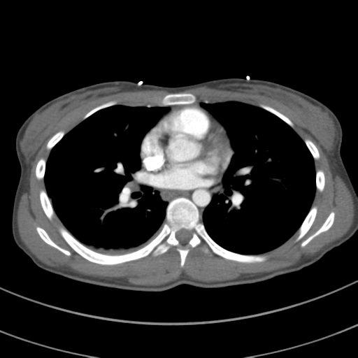 Abdominal multi-trauma - devascularised kidney and liver, spleen and pancreatic lacerations (Radiopaedia 34984-36486 Axial C+ arterial phase 45).png
