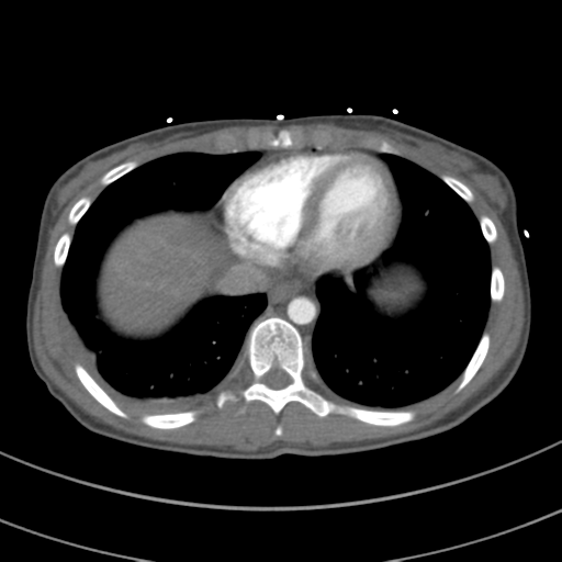 Abdominal multi-trauma - devascularised kidney and liver, spleen and pancreatic lacerations (Radiopaedia 34984-36486 Axial C+ arterial phase 65).png