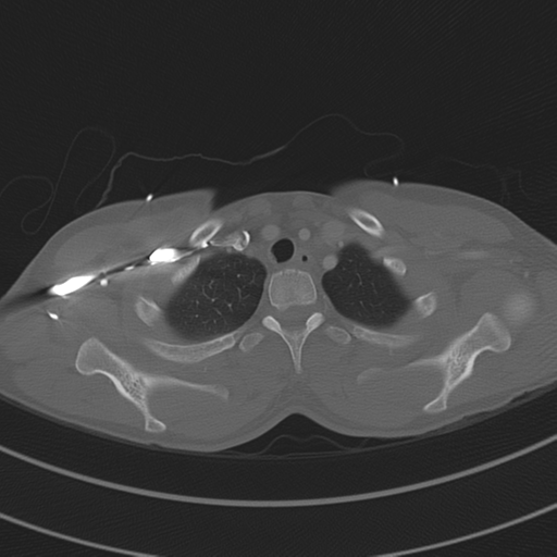 File:Abdominal multi-trauma - devascularised kidney and liver, spleen and pancreatic lacerations (Radiopaedia 34984-36486 I 15).png
