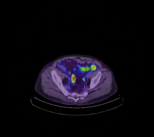 Abdominal wall metastasis from colorectal carcinoma (Radiopaedia 31016-31719 Axial 35).jpg