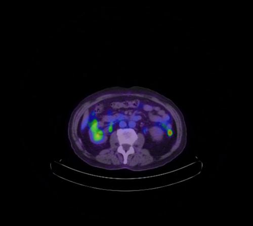 Abdominal wall metastasis from colorectal carcinoma (Radiopaedia 31016-31719 Axial 65).jpg