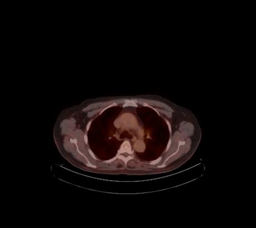 Abdominal wall metastasis from colorectal carcinoma (Radiopaedia 31016-31719 C 115).jpg