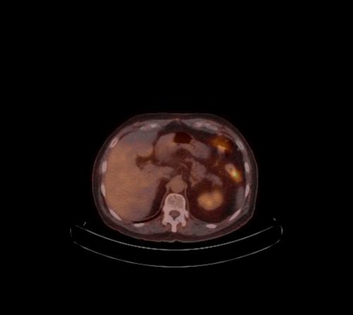 Abdominal wall metastasis from colorectal carcinoma (Radiopaedia 31016-31719 C 83).jpg