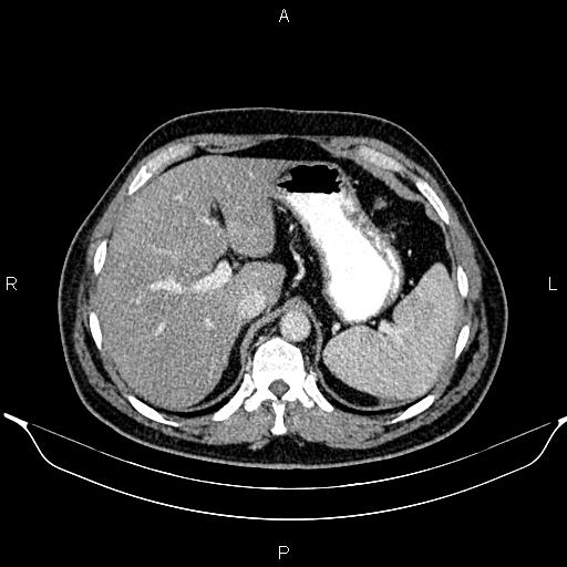 File:Aberrant right subclavian artery (Radiopaedia 87093-103354 Axial With contrast 110).jpg