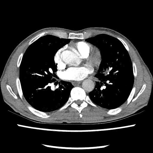 Accessory left horizontal fissure with lingular pneumonia (Radiopaedia 53763-59843 Axial C+ CTPA 53).jpg