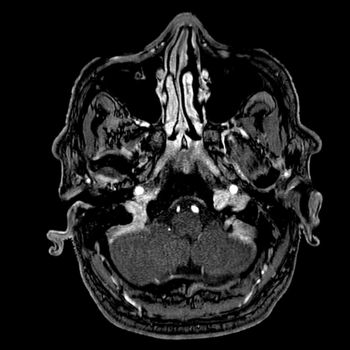 Accessory middle cerebral artery (Radiopaedia 73114-83828 Axial MRA 13).jpg
