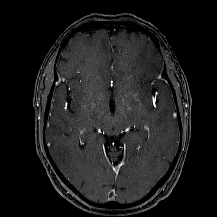 Accessory middle cerebral artery (Radiopaedia 73114-83828 Axial MRA 89).jpg