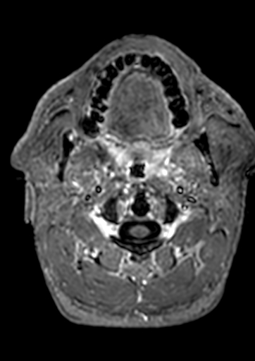 Accessory middle cerebral artery (Radiopaedia 73114-83828 Axial T1 C+ 229).jpg