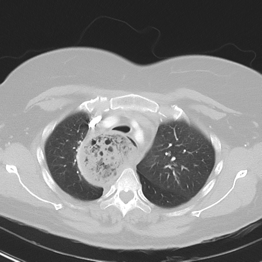 File:Achalasia (Radiopaedia 47147-51685 Axial lung window 13).png
