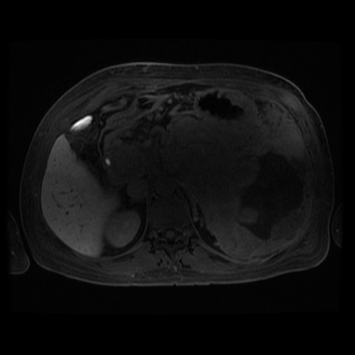 Acinar cell carcinoma of the pancreas (Radiopaedia 75442-86668 Axial late phase (~30 mins) 71).jpg
