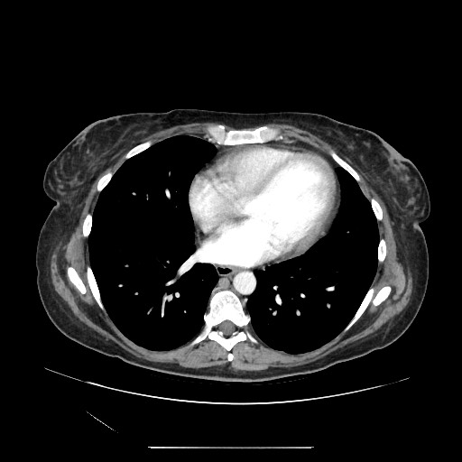 Acinar cell carcinoma of the pancreas (Radiopaedia 75442-86669 Axial C+ portal venous phase 1).jpg