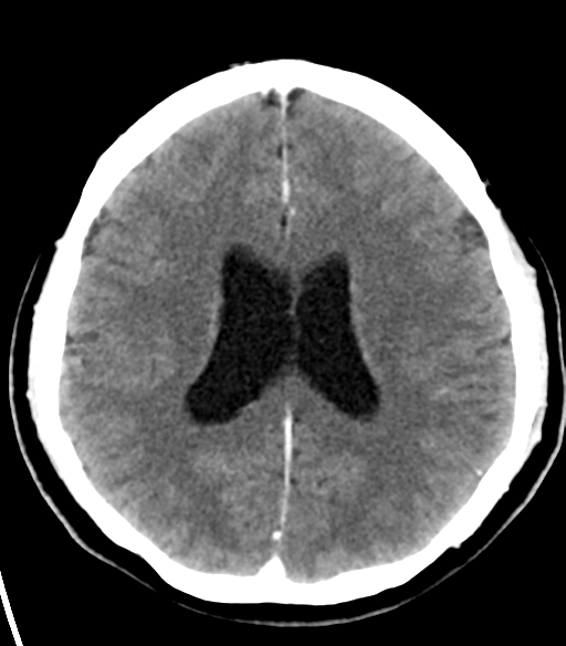 File:Acoustic schwannoma (Radiopaedia 33045-34065 Axial C+ delayed 17).png