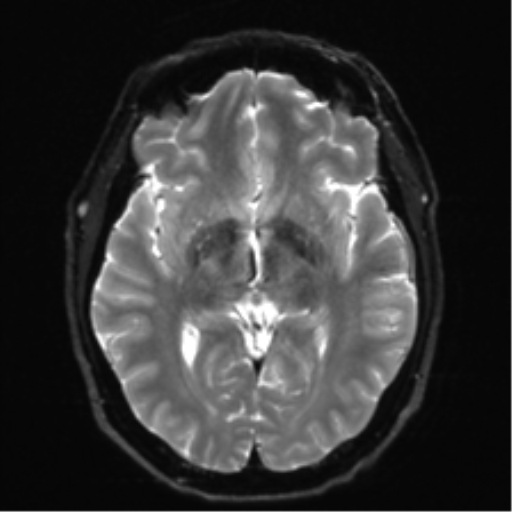 Acoustic schwannoma (Radiopaedia 50846-56358 Axial DWI 14).png