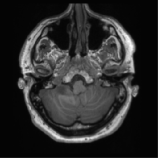 File:Acoustic schwannoma (Radiopaedia 50846-56358 Axial T1 9).png