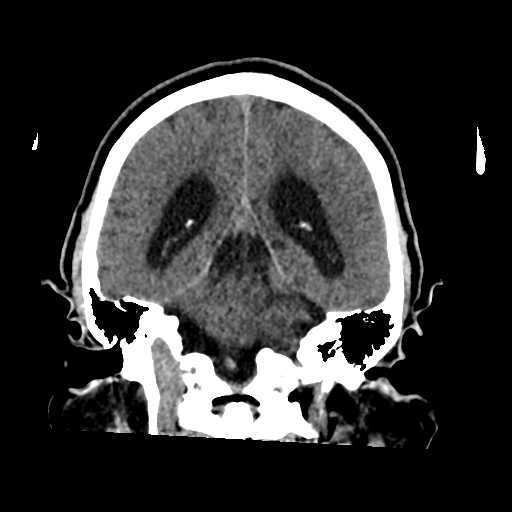 File:Acoustic schwannoma (Radiopaedia 55729-62280 Coronal non-contrast 27).png