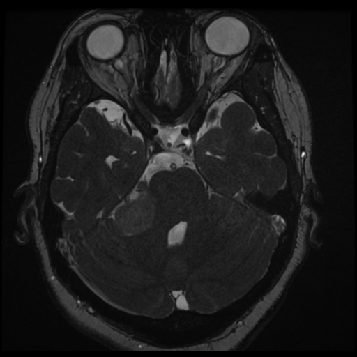 Acoustic schwannoma (Radiopaedia 57574-64536 Axial T2 58).png