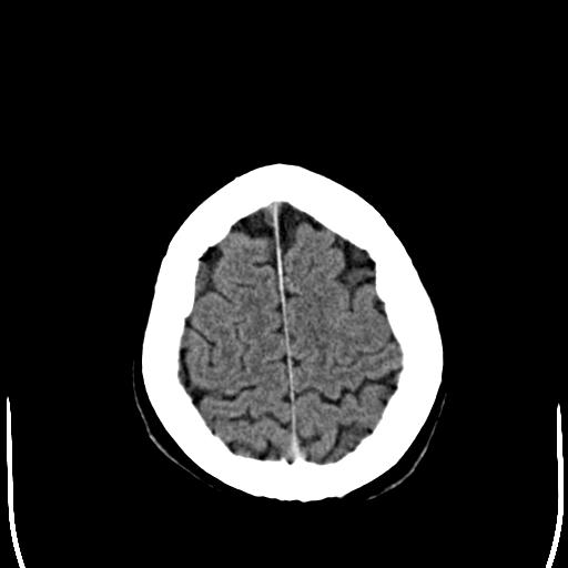 File:Acoustic schwannoma - cystic (Radiopaedia 29487-29980 AXIAL THICK non-contrast 24).jpg