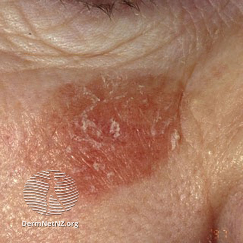 Actinic Keratoses affecting the face (DermNet NZ lesions-ak-face-232).jpg
