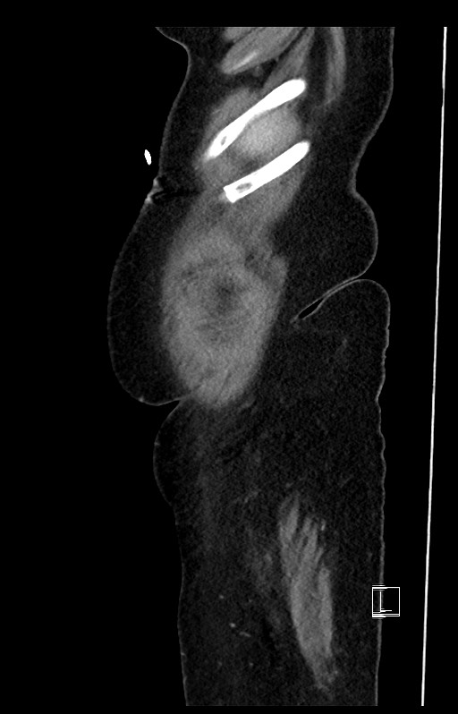 Active Crohn disease (Radiopaedia 59394-66750 Sagittal C+ portal venous phase 54).jpg
