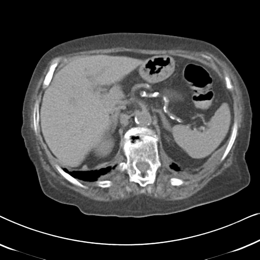 File:Active bleeding from duodenal ulcer with embolization (Radiopaedia 34216-35481 Axial non-contrast 20).png