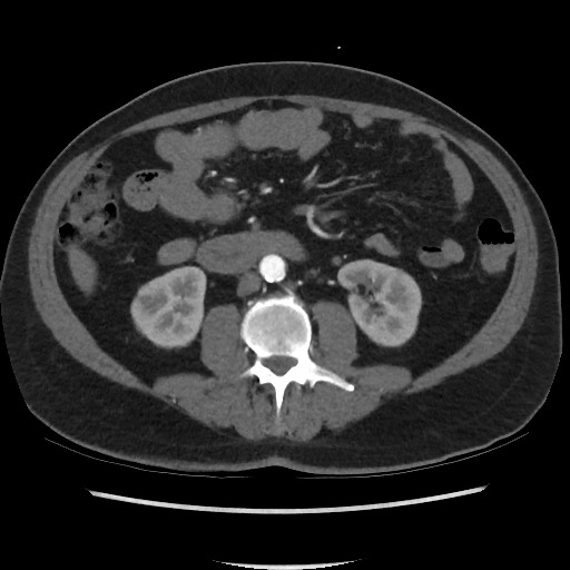 Active colonic bleed on CT (Radiopaedia 49765-55025 Axial C+ arterial phase 41).jpg