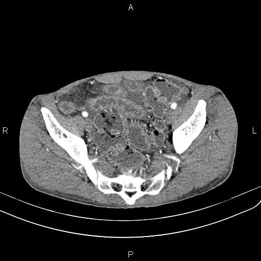 Active crohn disease (Radiopaedia 87133-103397 Axial C+ arterial phase 86).jpg