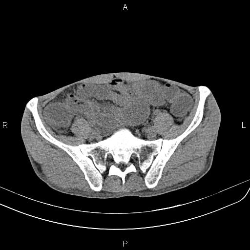 File:Active crohn disease (Radiopaedia 87133-103397 Axial non-contrast 77).jpg
