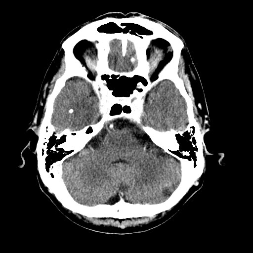 File:Active neurocysticercosis before and after therapy (Radiopaedia 71710-82099 Axial C+ delayed 78).jpg