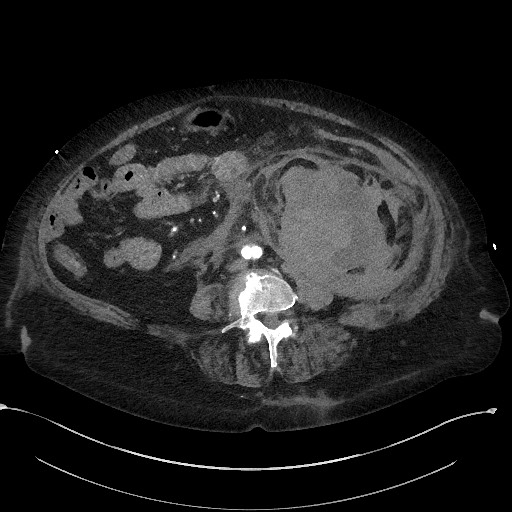 Active renal extravasation with large subcapsular and retroperitoneal hemorrhage (Radiopaedia 60975-68796 Axial C+ arterial phase 110).jpg