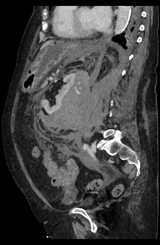 Active renal extravasation with large subcapsular and retroperitoneal hemorrhage (Radiopaedia 60975-68796 Sagittal C+ portal venous phase 99).jpg