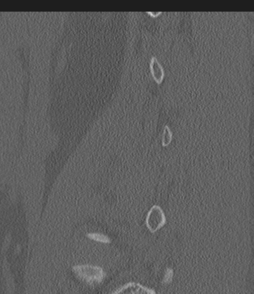 Acute L1 burst compression fracture (Radiopaedia 34430-35755 Sagittal bone window 51).png